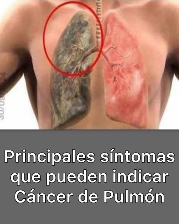 SÍNTOMAS DE CÁNCER DE PULMÓN