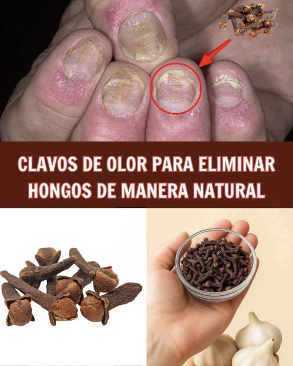 Clavos de Olor para Eliminar Hongos de las Uñas de Manera Natural