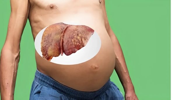 Jugos para purificar tu hígado: Una manera deliciosa de tratar el hígado graso