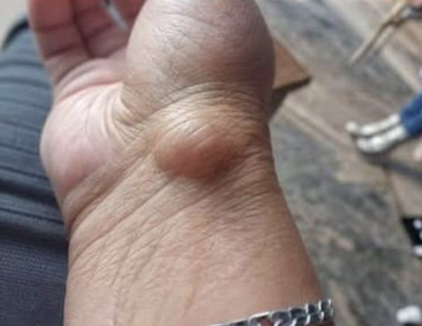 Ganglio de Muñeca: Causas, Síntomas y Tratamientos Efectivos.