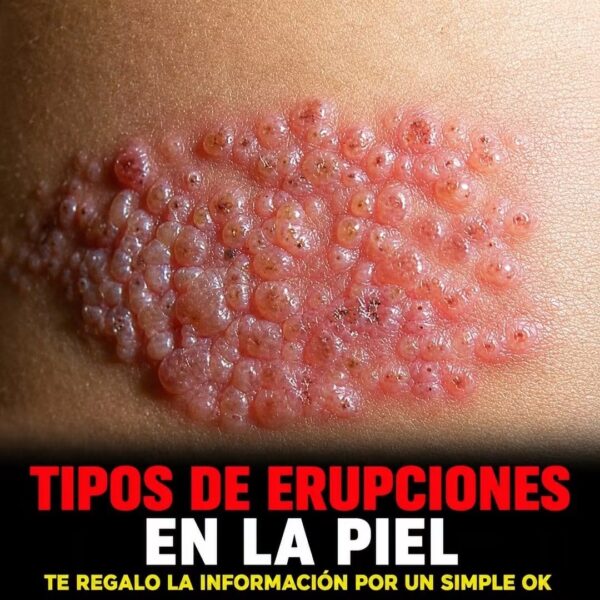 Tipos de erupciones en la piel