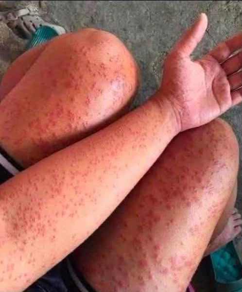 Estas lesiones en brazos y piernas pueden aparecer por diferentes razones