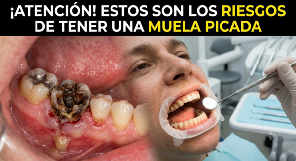 Estos son los riesgos de tener una muela picada ver más…….