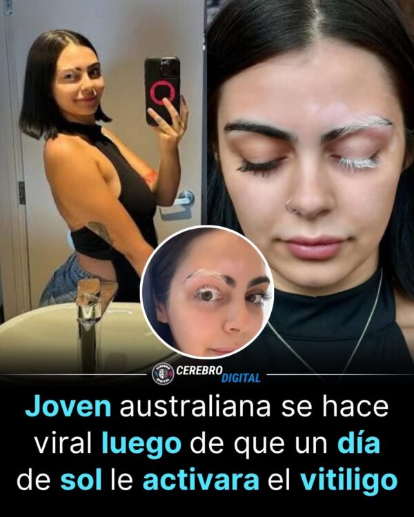 LA JOVEN QUE DESCUBRIÓ UNA ENFERMEDAD AUTOINMUNITARIA TRAS UN CAMBIO EN SU PIEL