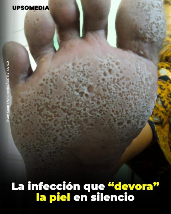 Bacterias de los pies