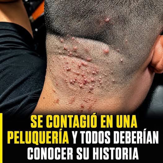 Alerta en peluquerías: una infección común tras un corte de cabello