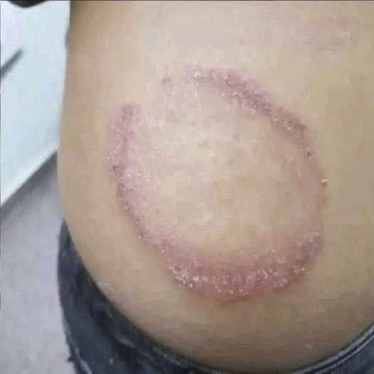 ESTOS SON LOS SIGNOS DE QUE PODRÍAS ESTAR DESARROLLANDO UNA INFECCIÓN POR HONGOS EN LA PIEL