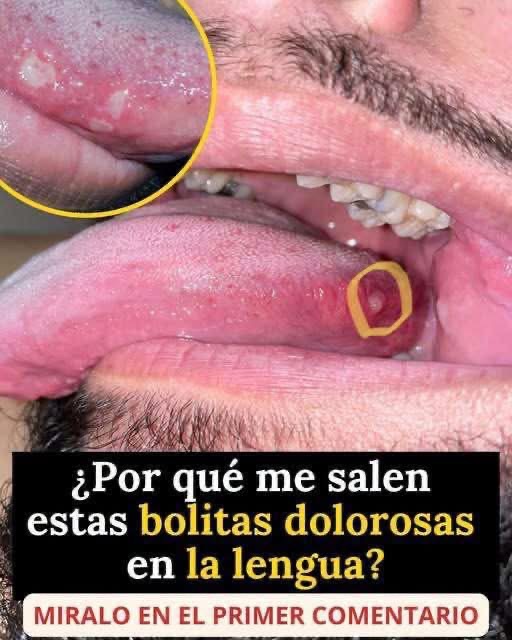 ¿POR QUÉ APARECEN ESAS “BOLITAS” DOLOROSAS EN LA LENGUA? ESTO ES LO QUE PODRÍAN SIGNIFICAR