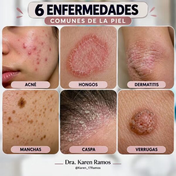 6 AFECCIONES CUTÁNEAS COMUNES QUE DEBERÍAS CONOCER