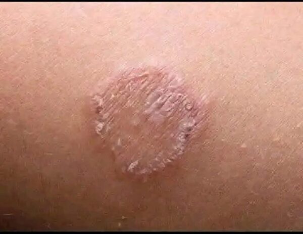 Cómo identificar y tratar las infecciones por hongos o la tiña en la piel