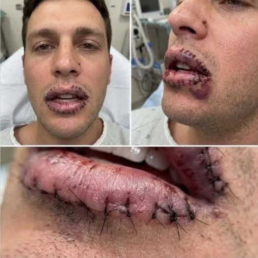 El peligro del pollo frito: Joven con puntos en los labios