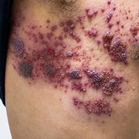 LESIONES CON AMPOLLAS Y SARPULLIDO: QUÉ PUEDEN SIGNIFICAR Y CUÁNDO BUSCAR ATENCIÓN MÉDICA