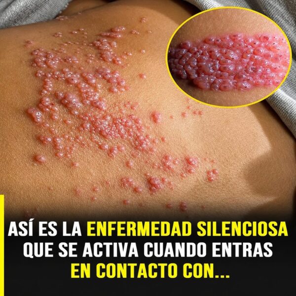 Tipos de erupciones en la piel