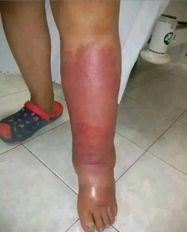 PRIMEROS SÍNTOMAS DE INFLAMACIÓN Y REMEDIOS NATURALES PARA ALIVIARLOS