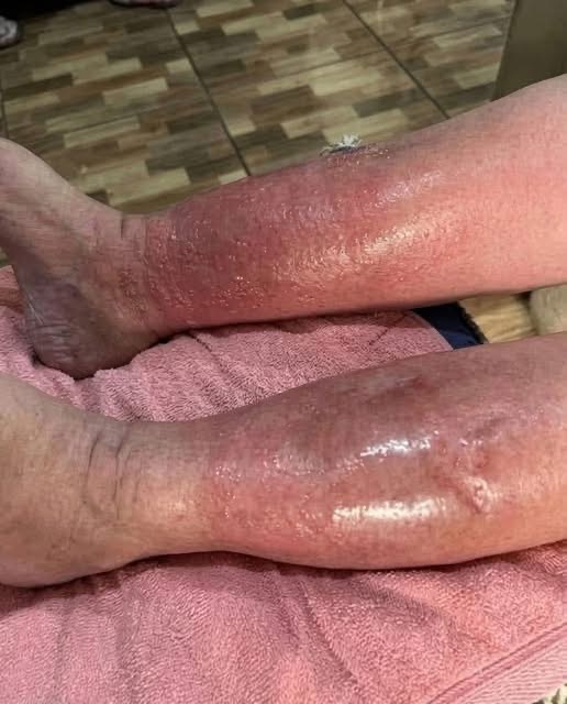 Trombosis Venosa Profunda (TVP): Síntomas, Tratamiento y Consejos para la Recuperación