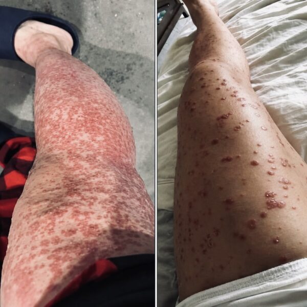 Psoriasis: qué es y cómo cuidar la piel en casa