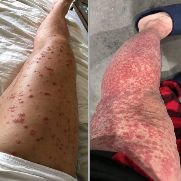 Psoriasis: qué es y cómo cuidar la piel en casa